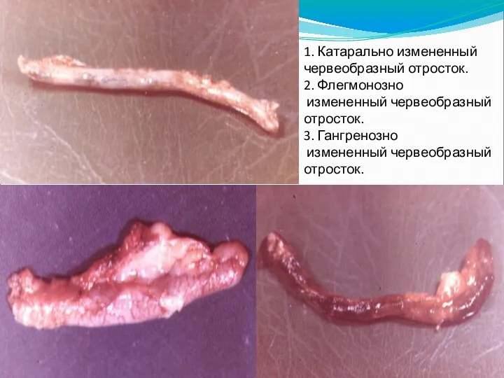 1. Катарально измененный червеобразный отросток. 2. Флегмонозно измененный червеобразный отросток. 3. Гангренозно измененный червеобразный отросток.