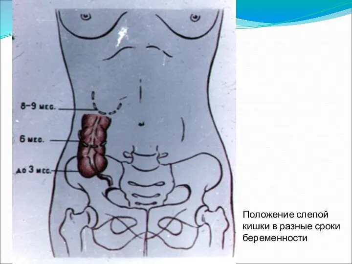 Положение слепой кишки в разные сроки беременности