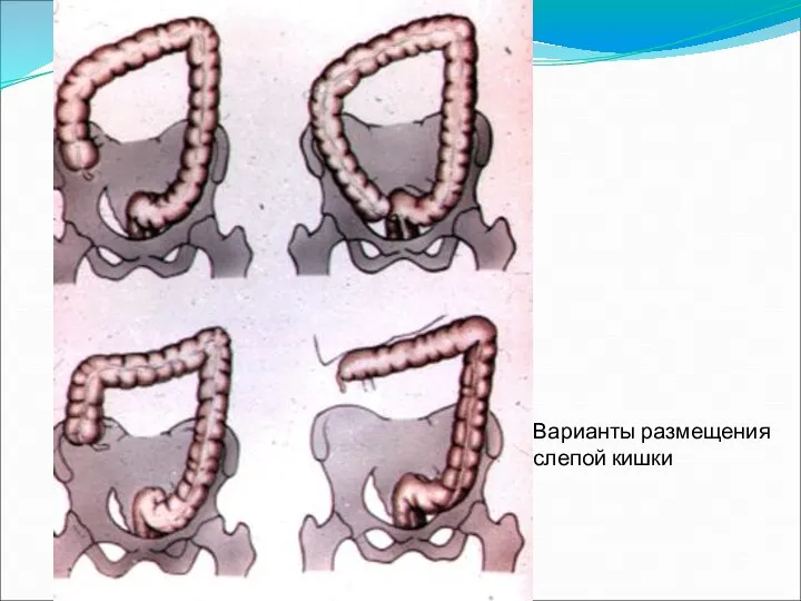 Варианты размещения слепой кишки