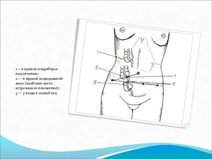 1— в правом подреберье под печенью; 2 — в правой подвздошной