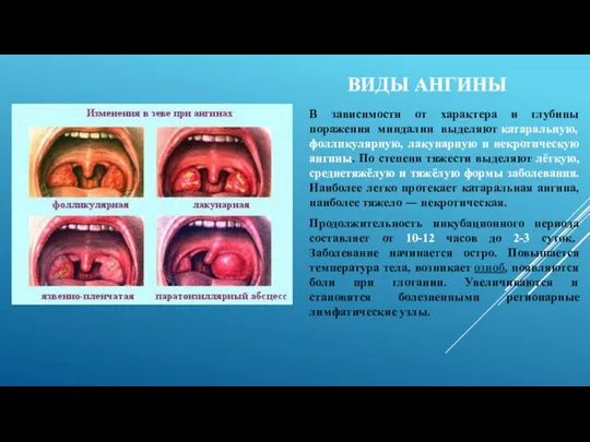 ВИДЫ АНГИНЫ В зависимости от характера и глубины поражения миндалин выделяют
