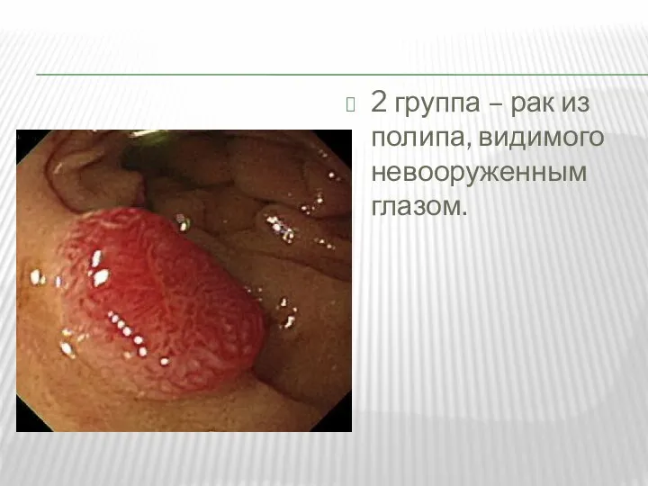 2 группа – рак из полипа, видимого невооруженным глазом.