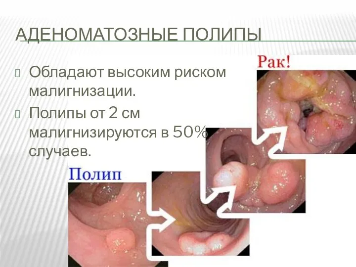 АДЕНОМАТОЗНЫЕ ПОЛИПЫ Обладают высоким риском малигнизации. Полипы от 2 см малигнизируются в 50% случаев.