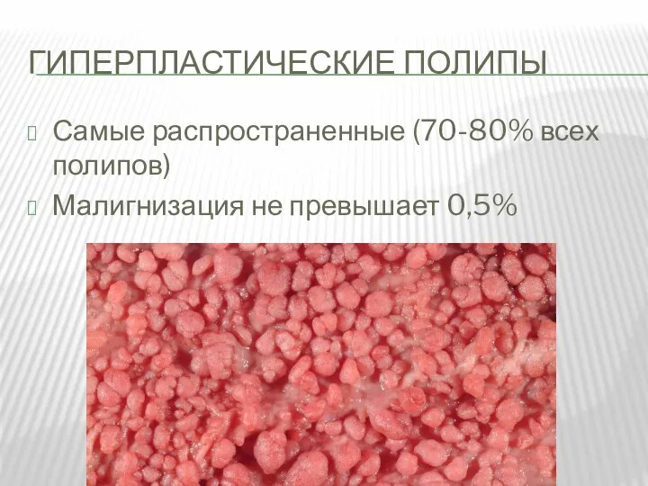 ГИПЕРПЛАСТИЧЕСКИЕ ПОЛИПЫ Самые распространенные (70-80% всех полипов) Малигнизация не превышает 0,5%