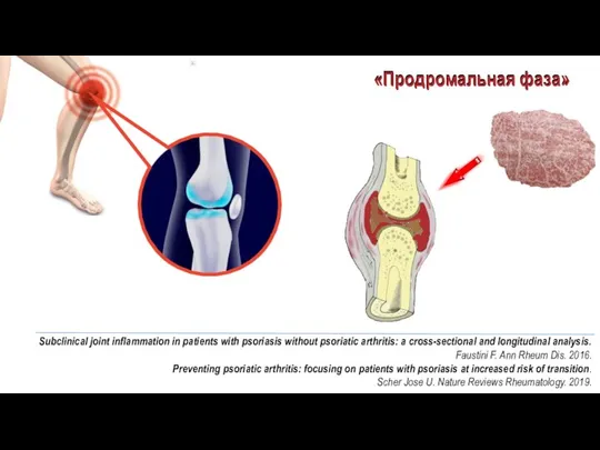 «Продромальная фаза» «Продромальная фаза» Subclinical joint inflammation in patients with psoriasis