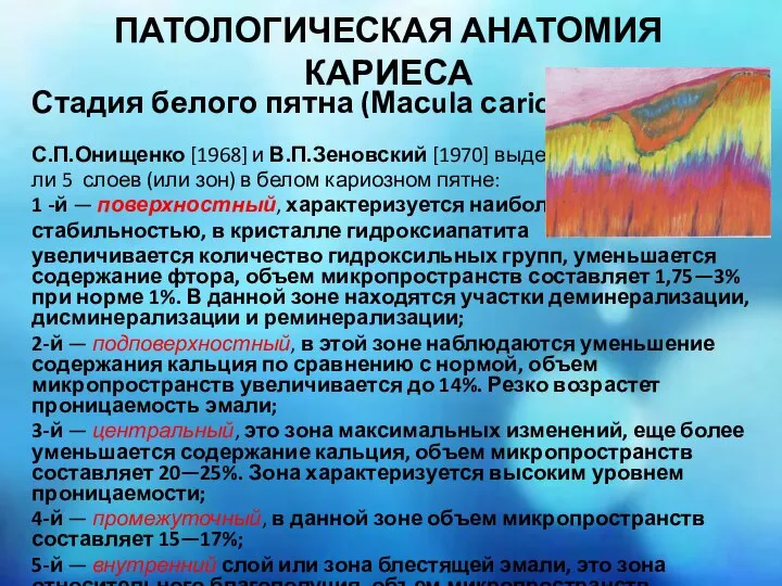 ПАТОЛОГИЧЕСКАЯ АНАТОМИЯ КАРИЕСА Стадия белого пятна (Масulа саriosa) С.П.Онищенко [1968] и