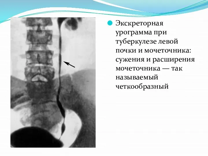 Экскреторная урограмма при туберкулезе левой почки и мочеточника: сужения и расширения мочеточника — так называемый четкообразный