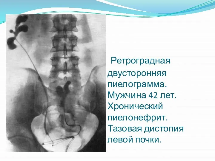 Ретроградная двусторонняя пиелограмма. Мужчина 42 лет. Хронический пиелонефрит. Тазовая дистопия левой почки.