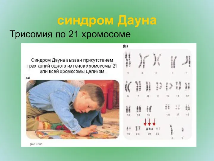 синдром Дауна Трисомия по 21 хромосоме