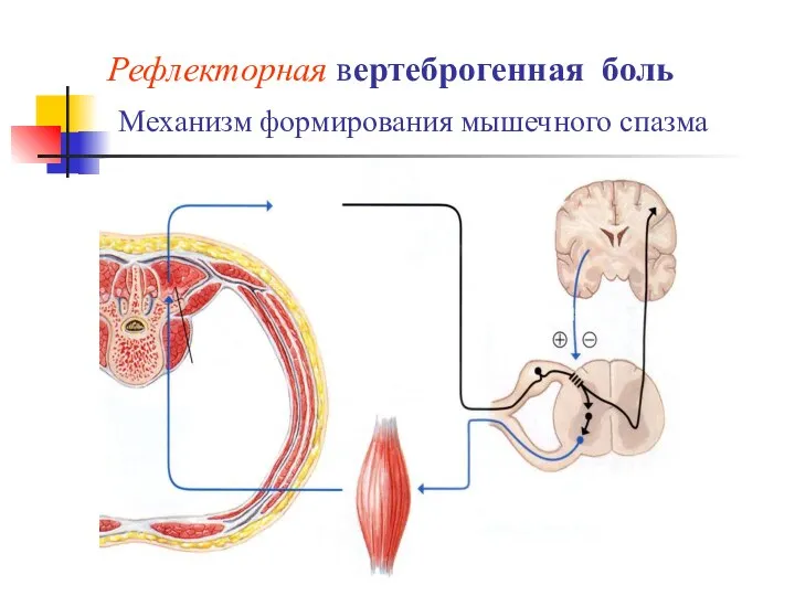 Рефлекторная вертеброгенная боль Механизм формирования мышечного спазма