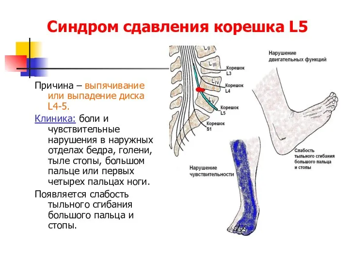 Синдром сдавления корешка L5 Причина – выпячивание или выпадение диска L4-5.
