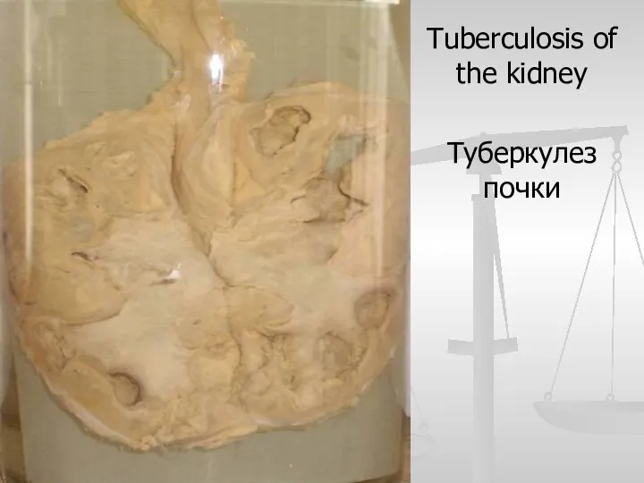 Tuberculosis of the kidney Туберкулез почки