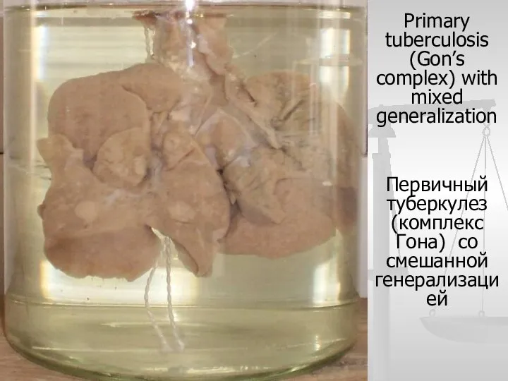 Primary tuberculosis (Gon’s complex) with mixed generalization Первичный туберкулез (комплекс Гона) со смешанной генерализацией