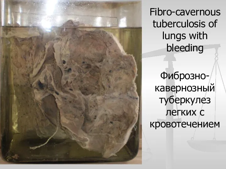 Fibro-cavernous tuberculosis of lungs with bleeding Фиброзно-кавернозный туберкулез легких с кровотечением