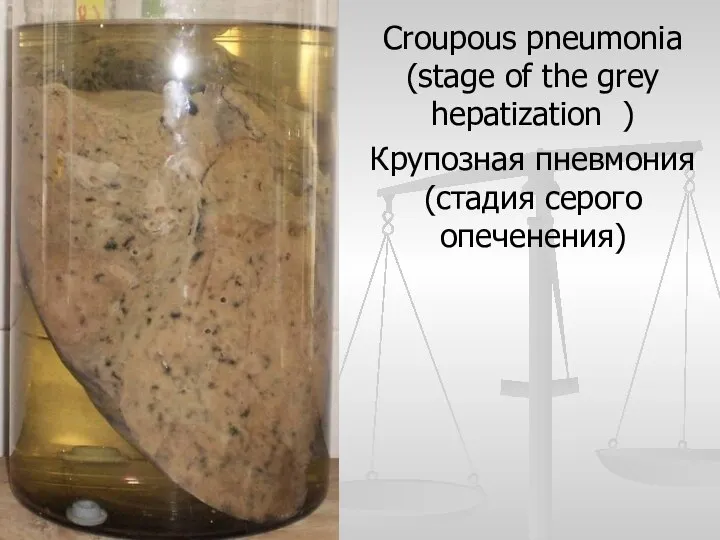 Croupous pneumonia (stage of the grey hepatization ) Крупозная пневмония (стадия серого опеченения)