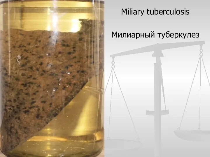 Miliary tuberculosis Милиарный туберкулез