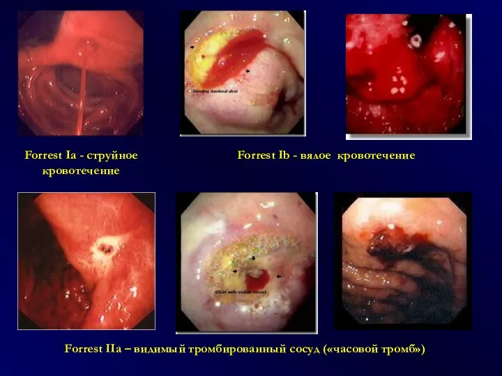 Forrest Ib - вялое кровотечение Forrest Ia - струйное кровотечение Forrest