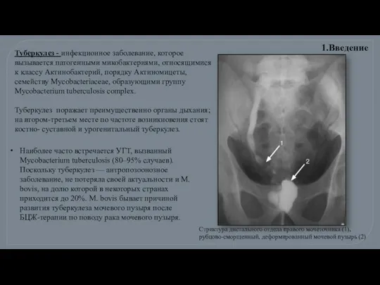 Туберкулез - инфекционное заболевание, которое вызывается патогенными микобактериями, относящимися к классу