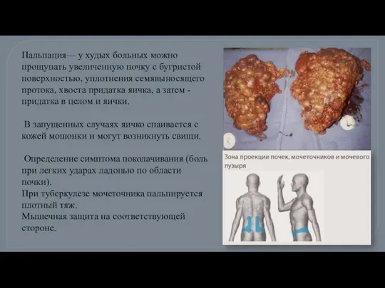 Пальпация— у худых больных можно прощупать увеличенную почку с бугристой поверхностью,