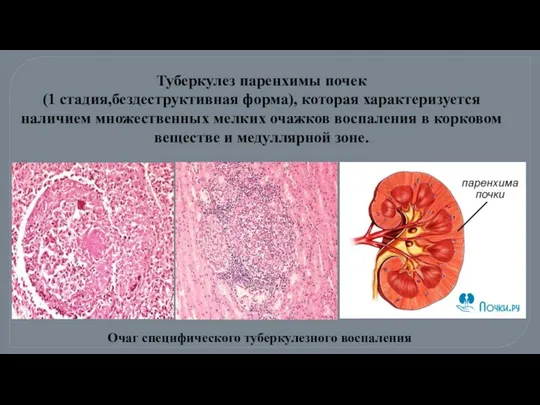 Очаг специфического туберкулезного воспаления Туберкулез паренхимы почек (1 стадия,бездеструктивная форма), которая