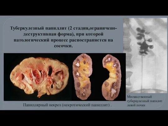 Множественный туберкулезный папилит левой почки Папиллярный некроз (некротический папиллит) . Туберкулезный