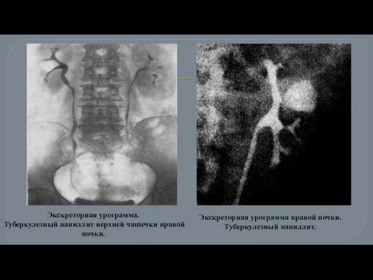 Экскреторная урограмма правой почки. Туберкулезный папиллит. Экскреторная урограмма. Туберкулезный папиллит верхней чашечки правой почки.