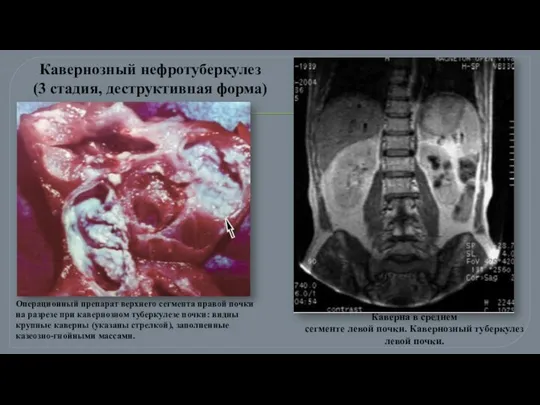 Операционный препарат верхнего сегмента правой почки на разрезе при кавернозном туберкулезе