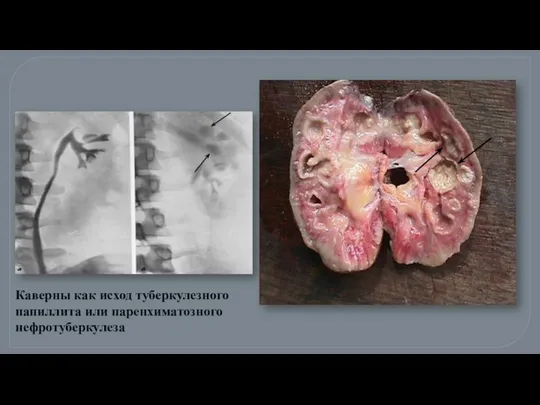 Каверны как исход туберкулезного папиллита или паренхиматозного нефротуберкулеза