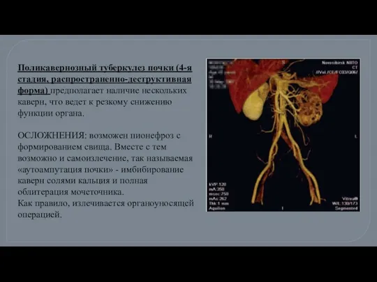 Поликавернозный туберкулез почки (4-я стадия, распространенно-деструктивная форма) предполагает наличие нескольких каверн,