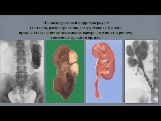 Поликавернозный нефротуберкулез (4 стадия, распостраненно-деструктивная форма)- предполагает наличие нескольких каверн, что