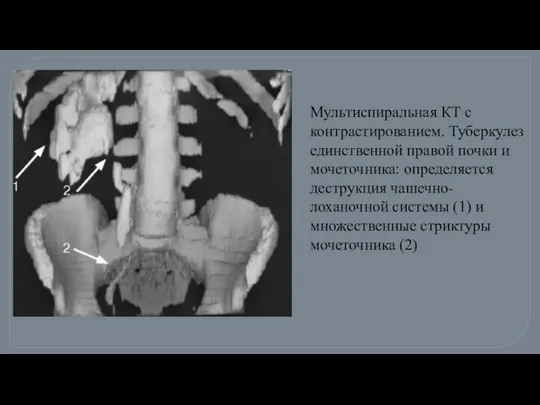 Мультиспиральная КТ с контрастированием. Туберкулез единственной правой почки и мочеточника: определяется