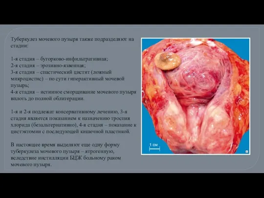 Туберкулез мочевого пузыря также подразделяют на стадии: 1-я стадия – бугорково-инфильтративная;