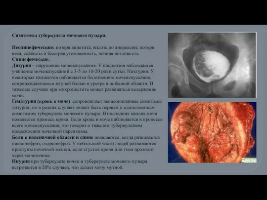 Симптомы туберкулеза мочевого пузыря. Неспицефические: потеря аппетита, вплоть до анорексии; потеря