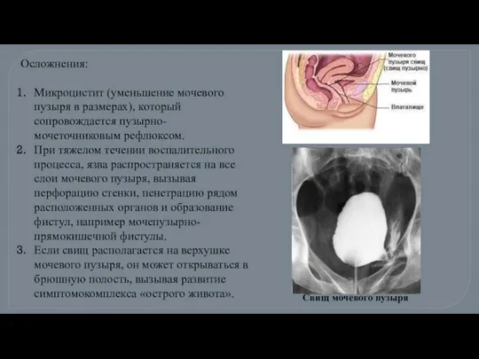 Осложнения: Микроцистит (уменьшение мочевого пузыря в размерах), который сопровождается пузырно-мочеточниковым рефлюксом.