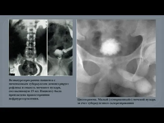 Цистограмма. Малый («сморщенный») мочевой пузырь за счет туберкулезного склерозирования Везикоуретерограмма пациента