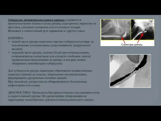 Туберкулез мочеиспускательного канала: поражаются преимущественно задние отделы уретры, куда процесс переходит