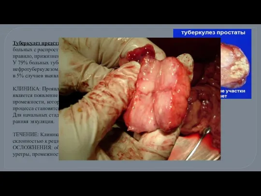 Туберкулез предстательной железы встречается у 77% больных с распространенными формами туберкулеза