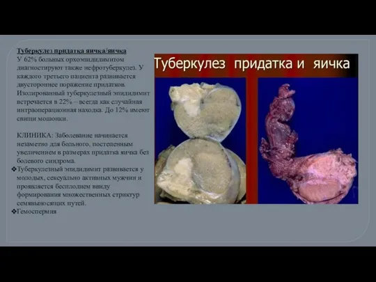 Туберкулез придатка яичка/яичка У 62% больных орхоэпидидимитом диагностируют также нефротуберкулез. У