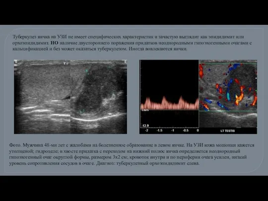Туберкулез яичка на УЗИ не имеет специфических характеристик и зачастую выглядит