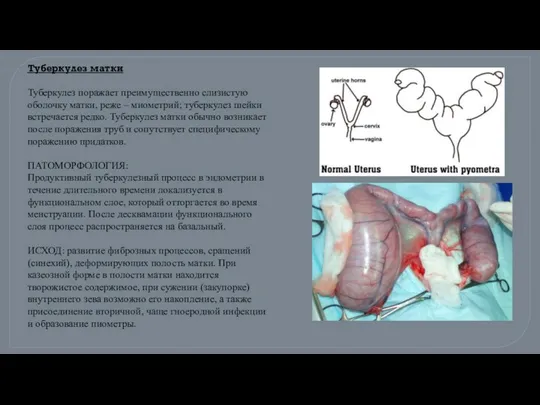 Туберкулез матки Туберкулез поражает преимущественно слизистую оболочку матки, реже – миометрий;