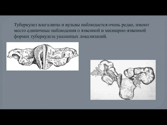 Туберкулез влагалища и вульвы наблюдается очень редко, имеют место единичные наблюдения