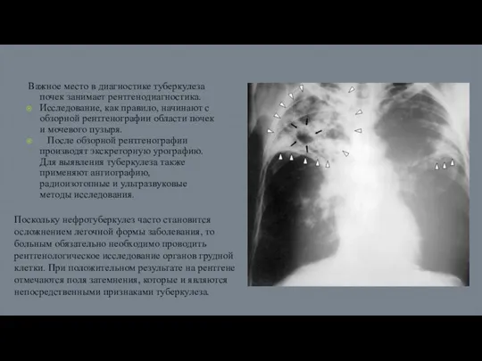 Важное место в диагностике туберкулеза почек занимает рентгенодиагностика. Исследование, как правило,