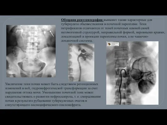 Обзорная рентгенография выявляет также характерные для туберкулеза обызвествления в почечной паренхиме.