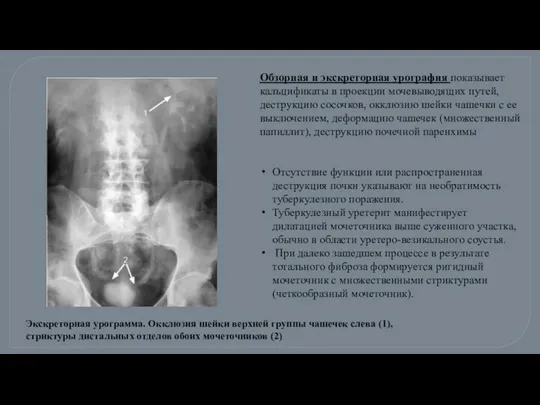 Обзорная и экскреторная урография показывает кальцификаты в проекции мочевыводящих путей, деструкцию