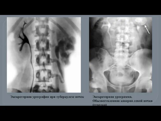 Экскреторная урография при туберкулезе почек Экскреторная урограмма. Обызвествленная каверна левой почки (стрелка)