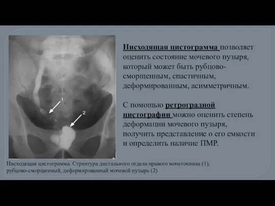 Нисходящая цистограмма. Стриктура дистального отдела правого мочеточника (1), рубцово-сморщенный, деформированный мочевой