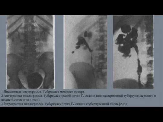 1.Нисходящая цистограмма. Туберкулез мочевого пузыря. 2.Антеградная пиелограмма. Туберкулез правой почки IV