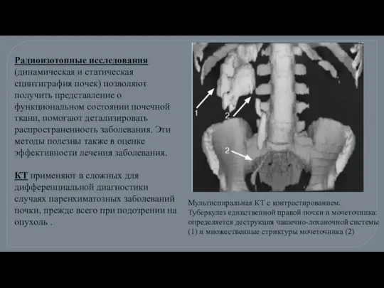 Радиоизотопные исследования (динамическая и статическая сцинтиграфия почек) позволяют получить представление о