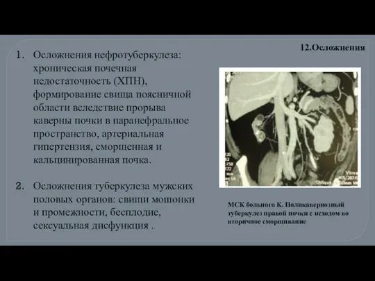 Осложнения нефротуберкулеза: хроническая почечная недостаточность (ХПН), формирование свища поясничной области вследствие