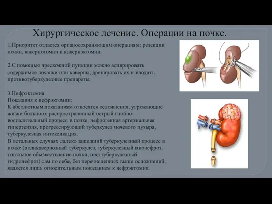 1.Приоритет отдается органосохраняющим операциям: резекции почки, кавернотомии и кавернэктомии. 2.С помощью